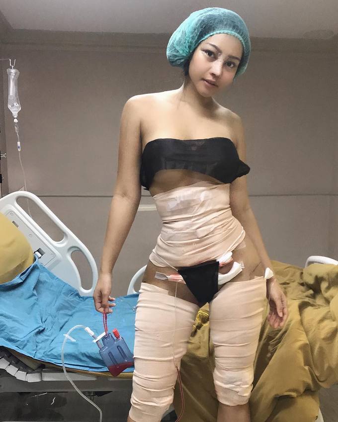 16.Hot girl Thái Lan công khai ảnh phẫu thuật eo thon, đùi gọn2