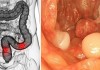 Ung thư đại trực tràng: Người và nghề nào sẽ có nguy cơ mắc bệnh cao?