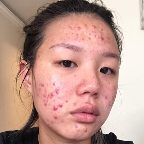 Làn da dày đặc mụn bọc, vết sưng đỏ từng khiến Hana Lee rất khổ sở.