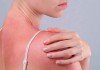 Ngộ độc ánh nắng mặt trời – tình trạng nguy hiểm cần được nhận biết ngay