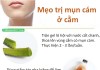 5 mẹo đánh bay mụn cám ở cằm