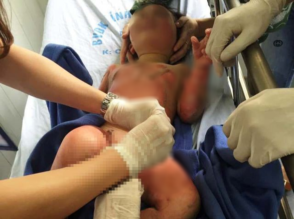 Một cháu bé bị bỏng nặng được các bác sĩ cấp cứu tại Bệnh viện đa khoa tỉnh Hà Nam - Ảnh: CTV