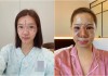 Lưu Đê Ly phẫu thuật thẩm mỹ toàn mặt