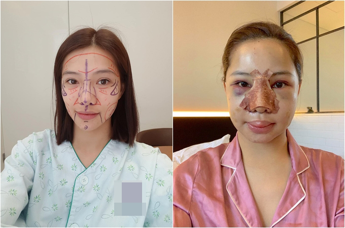 Gương mặt Lưu Đê Ly trước và sau khi phẫu thuật.