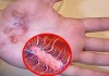 Bác sĩ BV Bạch Mai chỉ rõ 5 cách ngăn chặn sự tấn công của vi khuẩn ăn thịt người