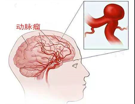 27. Được ví như 'bom nổ chậm' - phình động mạch não nguy hiểm đến mức nào1