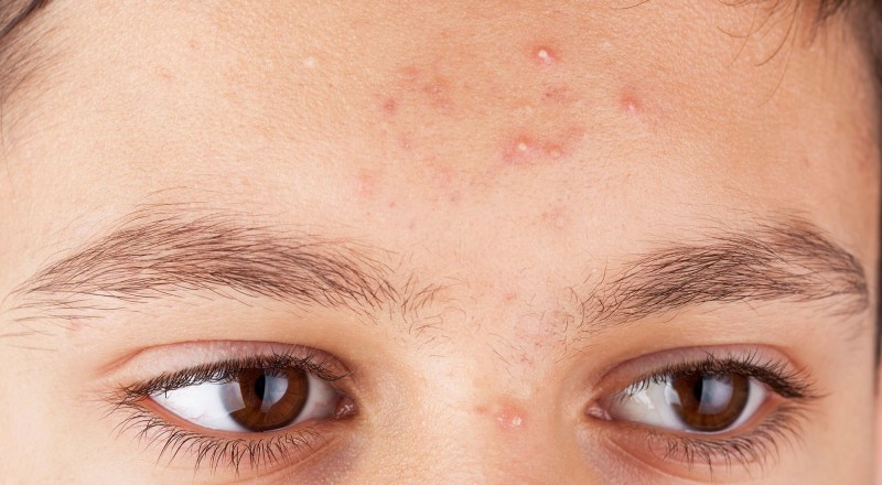 5 vấn đề phổ biến về da và cách chữa trị nhanh chóng4