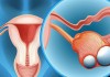 Chuyên gia giải thích tại sao ung thư buồng trứng thường bị chẩn đoán nhầm
