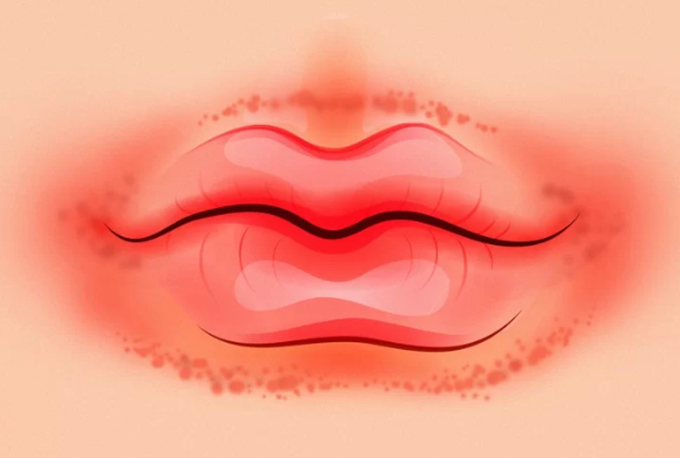 Viền đỏ quanh môi Đây là dấu hiệu phổ biến nhất của chứng viêm da quanh môi thường xuất hiện ở người có thói quen liếm môi. Cách tốt nhất là hãy từ bỏ thói quen này và thoa thêm các chất dưỡng ẩm như Vaseline để làm dịu đồng thời bổ sung độ ẩm cho vùng da quanh môi.