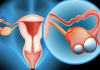 Cô gái 23 tuổi chưa kết hôn đã bị ung thư dạ dày di căn buồng trứng, cảnh báo những thói quen xấu nhiều người mắc