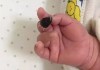 Bé 6 tháng tuổi phải cắt bỏ ngón tay giữa, nguyên nhân do thói quen mẹ nào cũng mắc