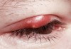 Mụn nổi ở mí mắt trên: dấu hiệu và cách xử lý để bạn bớt cảm thấy khó chịu