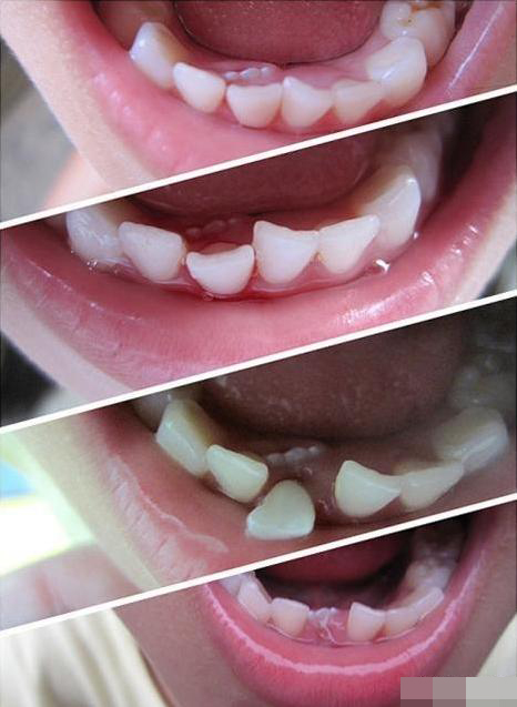 Nếu răng sữa của é dày và khít khi răng mới mọc lên thay thế sẽ không có chỗ, dẫn đến mọc lệch vị trí