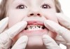 Trẻ có hàm răng cửa to và thưa là tốt hay xấu?