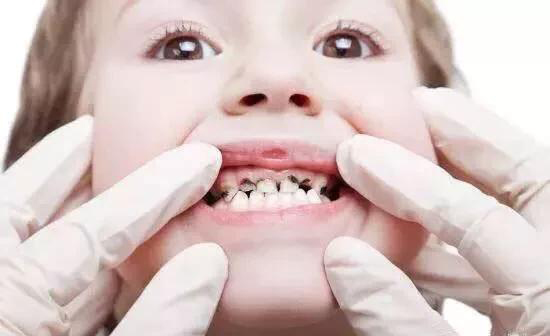 Nên vệ sinh kịp thời sau khi ăn để tránh vi khuẩn sản sinh và gây sâu răng.