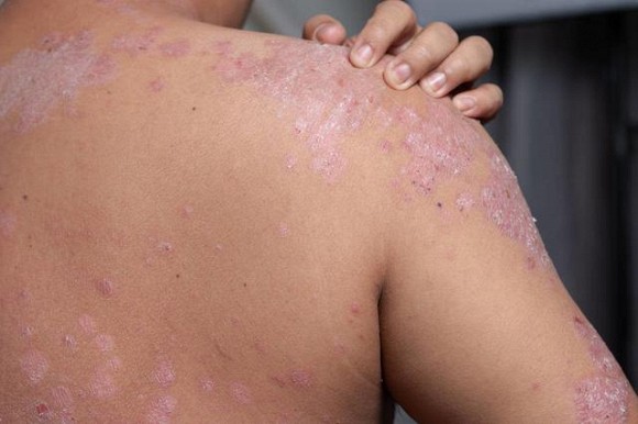 3.Phân biệt 4 loại bệnh về da phổ biến vào mùa xuân