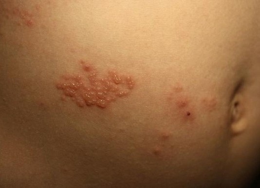 Phân biệt 4 loại bệnh về da phổ biến vào mùa xuân: Cách phòng và điều trị