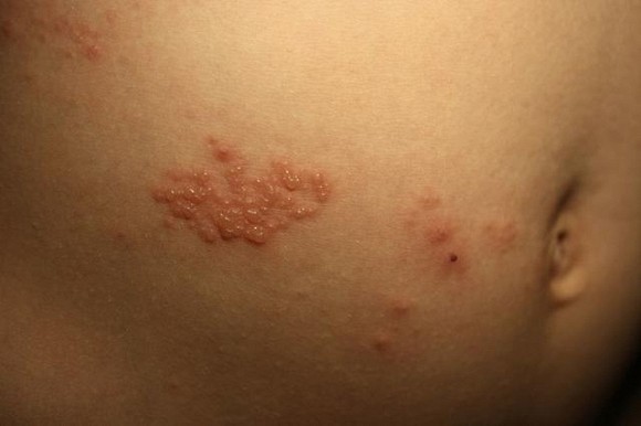 3.Phân biệt 4 loại bệnh về da phổ biến vào mùa xuân1