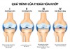 Thoái hóa khớp gối: Nguyên nhân và biện pháp khắc phục hiệu quả, an toàn