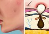 6 loại mụn thường gặp và nguyên nhân