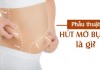 Hút mỡ bụng và những sai lầm biến chứng thường gặp dẫn đến tử vong