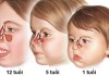 Những điều cần biết về viêm xoang ở trẻ