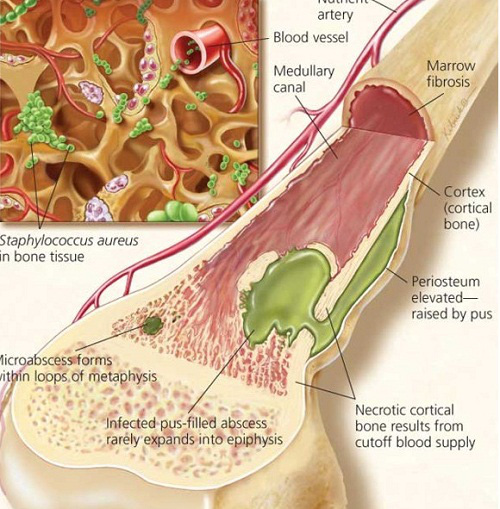 viemxuogntuyxuongtrieuchungvaphuongphapdieutri1-15784566209911123844147