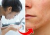 6 sai lầm khi chăm sóc khiến da dễ nổi mụn