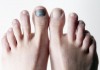 Đen móng chân do chạy bộ: Nguyên nhân và cách khắc phục