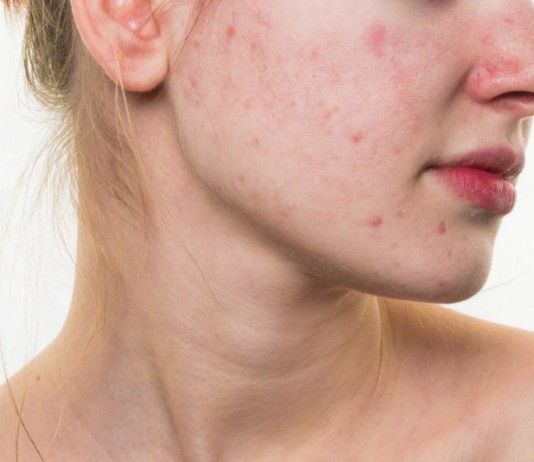 3 cách kết hợp mỹ phẩm có thể làm da kích ứng