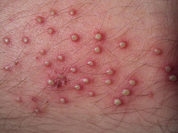 folliculitis-16033326940871850312240