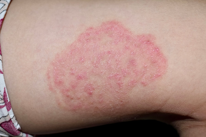 tinea-corporis-16033356111252001438795