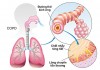 Tất tần tật các cách giảm khó thở khi bị COPD