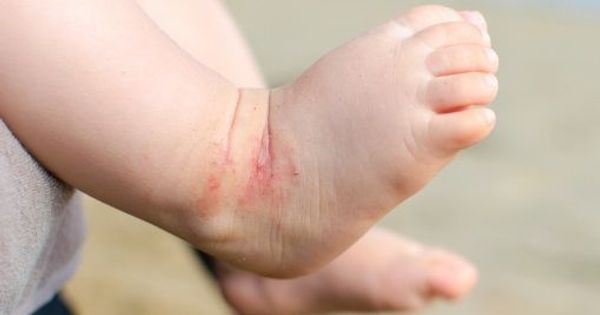 eczema-atopique-1606128991383805182096