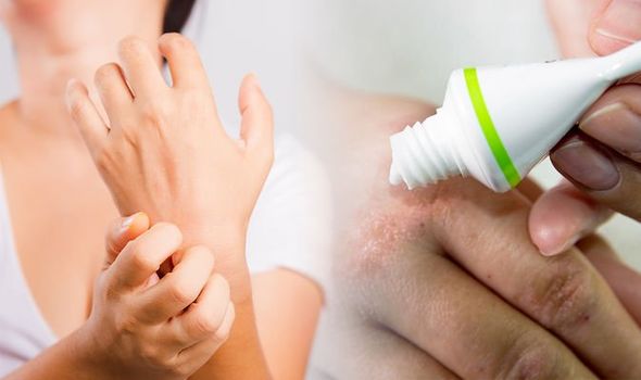 eczema-treatment-an-unusual-treatment-could-help-to-soothe-the-skin-1313807-1606128539097405345313