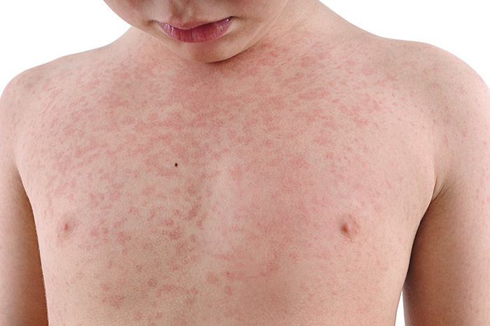 measles-vaccine-16043854608101932304696