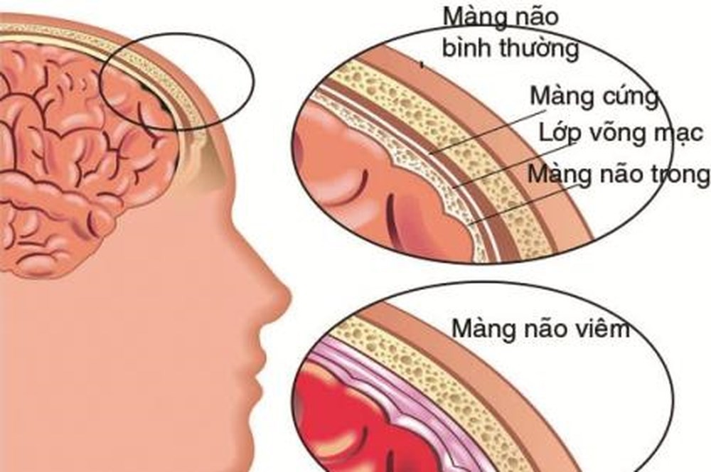 bien-chung-cua-benh-tay-chan-mieng-co-the-gay-tu-vong1-15308758178831696024163