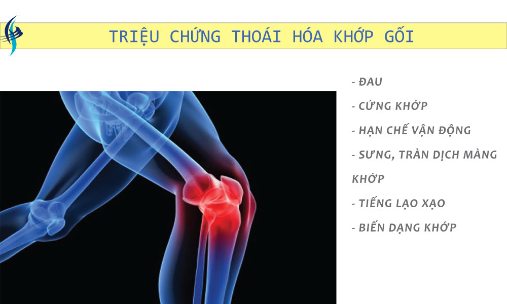 thoái hóa khớp 1