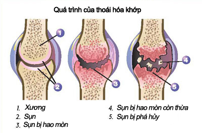 thoái hóa khớp